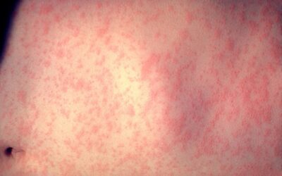 Sheffield below international guidelines for measles vaccine