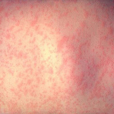 Sheffield below international guidelines for measles vaccine